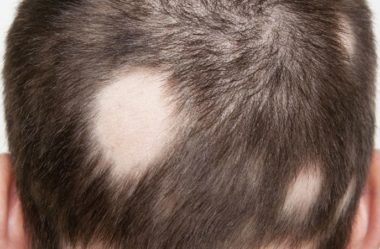Alopecia Areata: o que é e de que modo tratar?