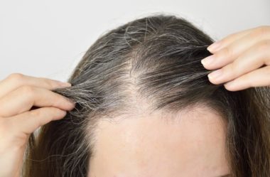 Alopecia Areata: o que é e de que modo tratar?